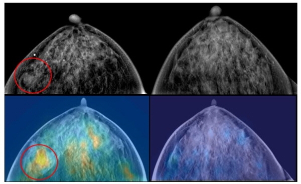 임상 결과 병변(동그라미)이 X-선 영상(좌측상단)에서는 유방암 여부가 불확실 했으나, 근적외선 영상(좌측하단)을 융합했을 때는 유방암을 확인할 수 있다. 우측(상, 하)은 정상 유방 소견